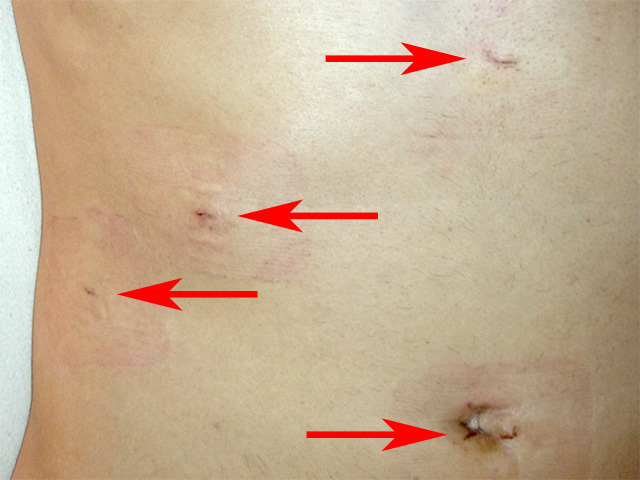 Laparoscopic chole scars 